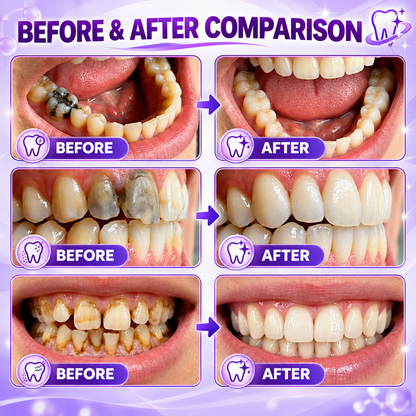 TERVENCE® DenPerm Cavity-Repair Natural Enamel Filling Gel