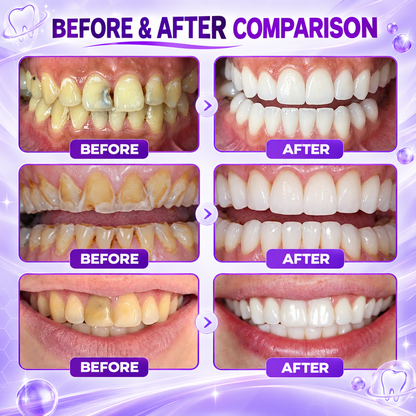 TERVENCE® DenPerm Cavity-Repair Natural Enamel Filling Gel